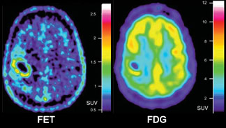 FET vs. FDG imaging a maliganant brain tumor