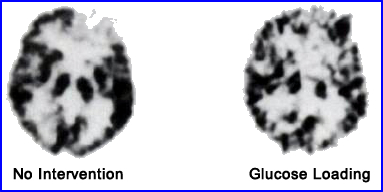 Resutls of glucose loading in brain imaging