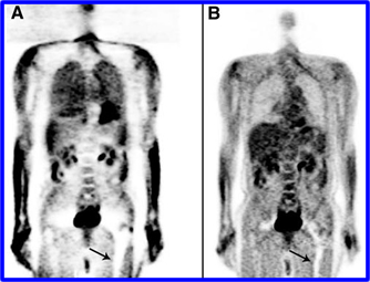 A - PET Corrected with CT and B - Not corrected with CT