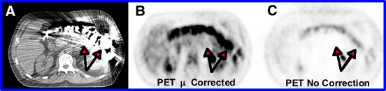 PET/CT with Barium 