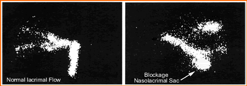Dacryoscintigraphy - Normal and abnormal
