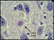Lewy Bodies surrounded by normal neurons