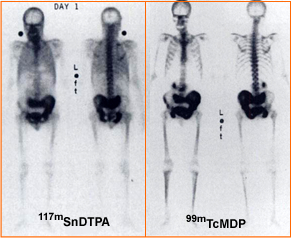117mSnDTPA Compared to 99mTcMDP