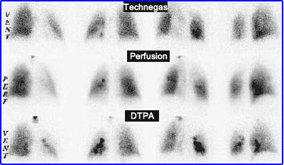 Technegas vs DTPA