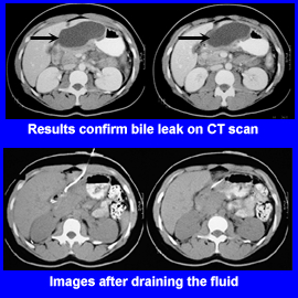 CT Before and after treatment
