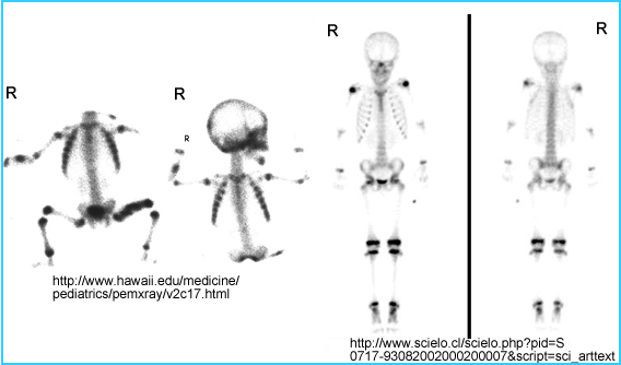 infant and child bone scan