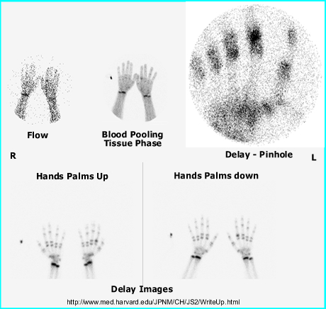 Three Phase Bone Scan of Hands