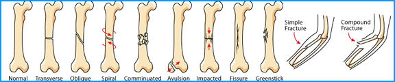 Types of Bone Fractures