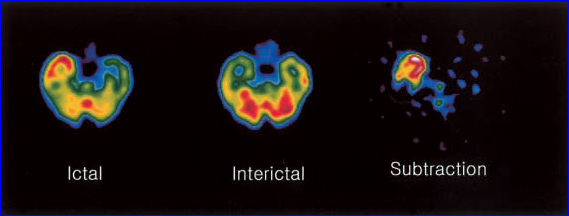 Ictal and Interictal States