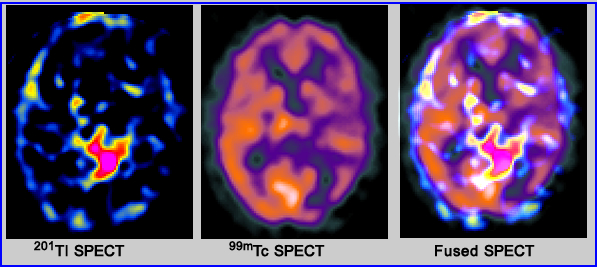 Glioblastoma imaged with Tl-201 and Tc-99m
