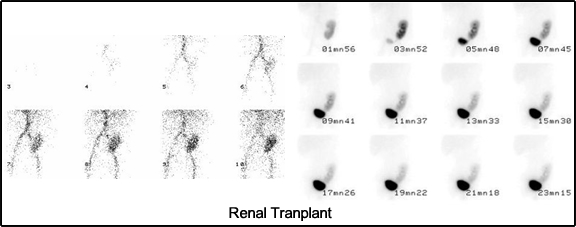 Images of renal transplant