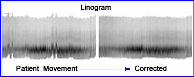 Linogram showing patient movement