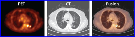 PVE noted in PET/CT images