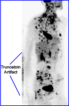 Truncatoin artifact seen in PET scan