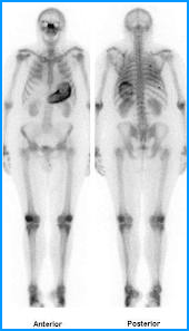 Bone scan: What does it show?