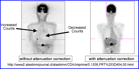 PET image showing improved image quality when attenuation correction is applied